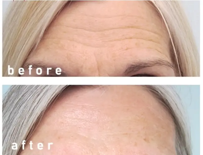 تصاویر قبل و بعد از تزریق ژل